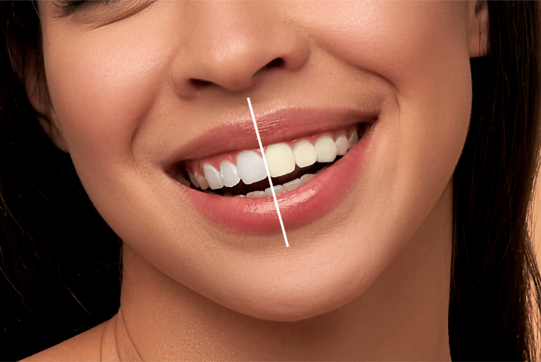 Invisalign Treatments in Hertfordshire: Tailored for Your Unique Smile